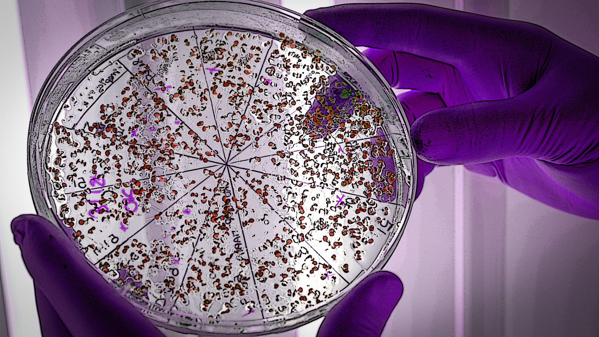 Transferencia de masa fecal, microbiota intestinal y COVID-19
