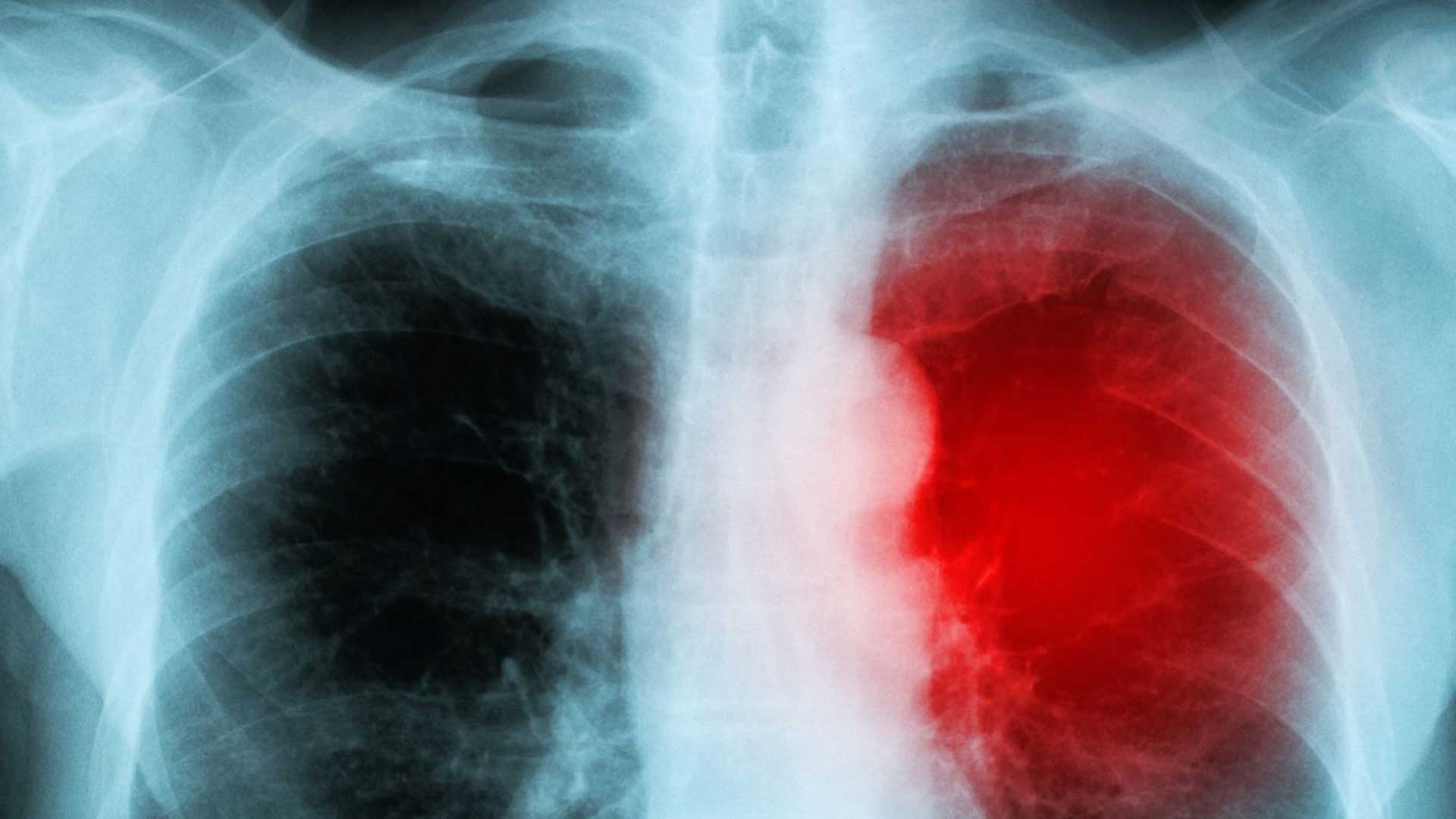 La miocarditis no es un efecto significativo de las vacunas, pero sí de COVID-19